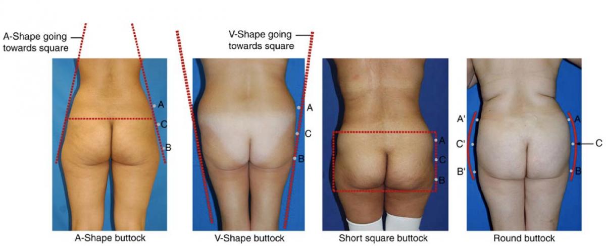 24.2 forma buttocks