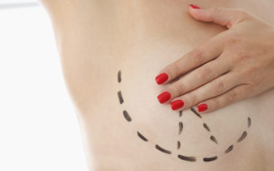 ¿Qué cicatrices deja una elevación de senos o mastopexia?