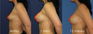 Evolución de un pecho con mamas tuberosas tra operarse: antes, un mes y 12 meses