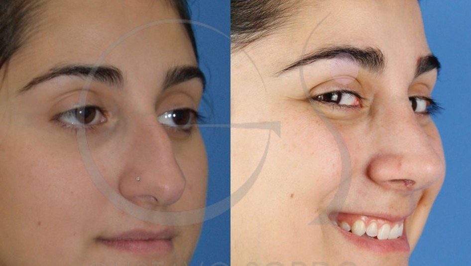 Postoperatorio rinoplastia ultrasónica: recuperación operación de nariz