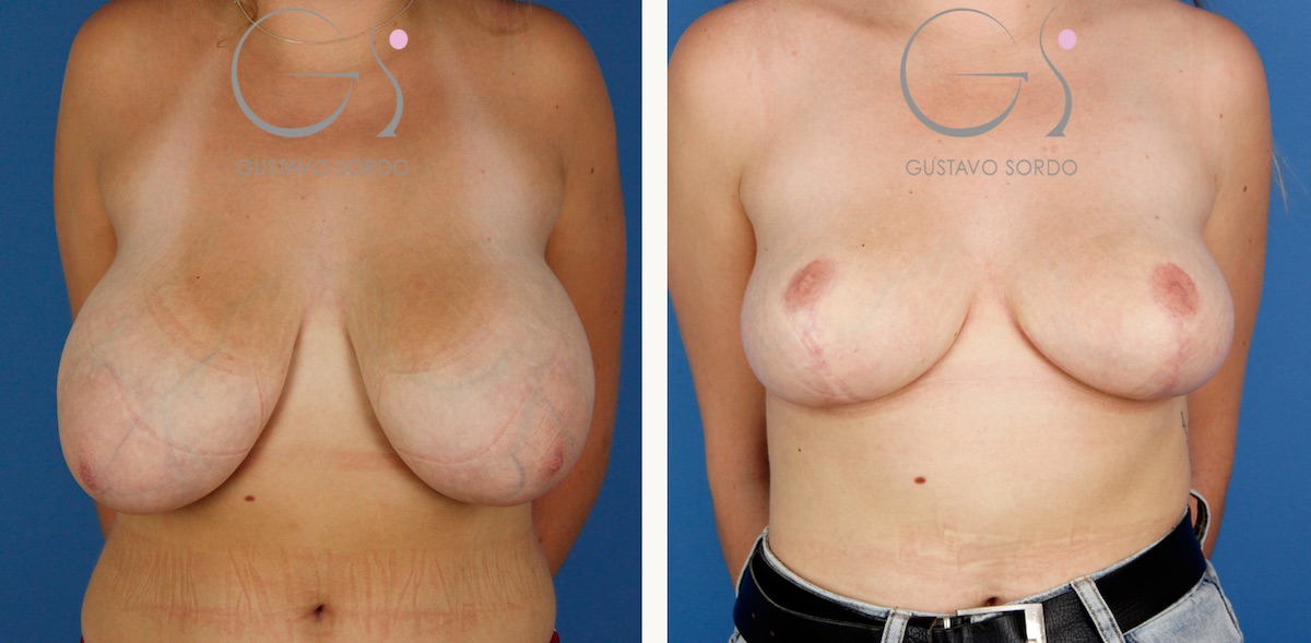 Reducción mamaria sin implantes