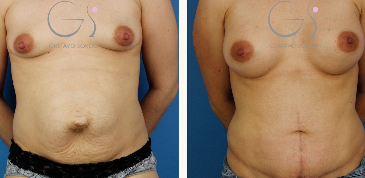 Abdominoplastia con reconstrucción de eventración abdominal