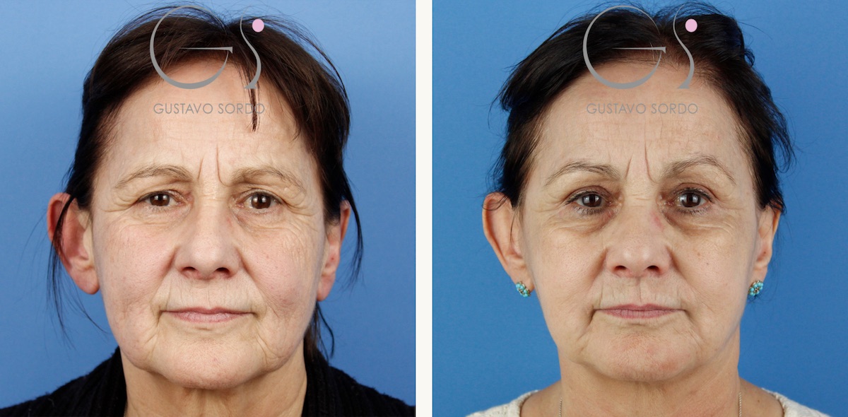 Rejuvenecimiento facial en una mujer de 65 años