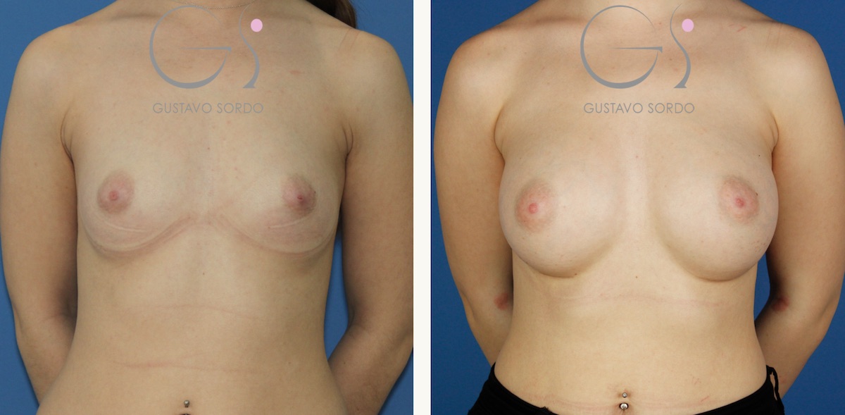Aumento de mamas con prótesis de 330 cc. anatómicas