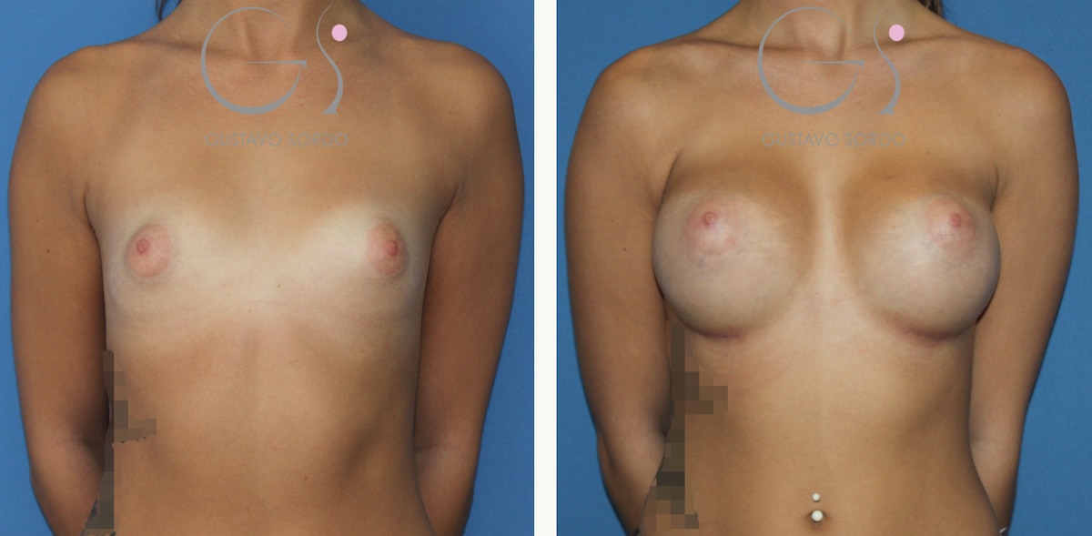Corrección de mamas tuberosas con implantes anatómicos