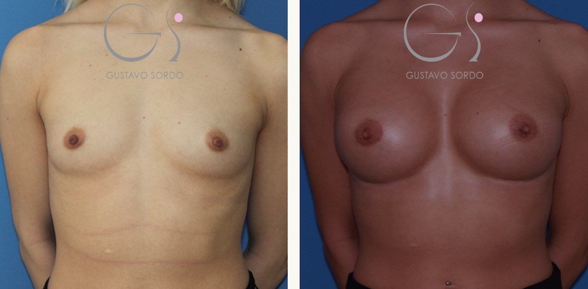 Paciente con implantación mamaria alta. Aumento de pecho