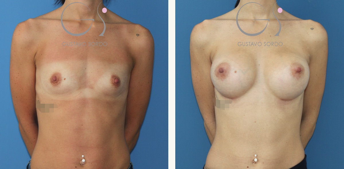 Resultado con implantes mamarios anatómicos de 390 cc.