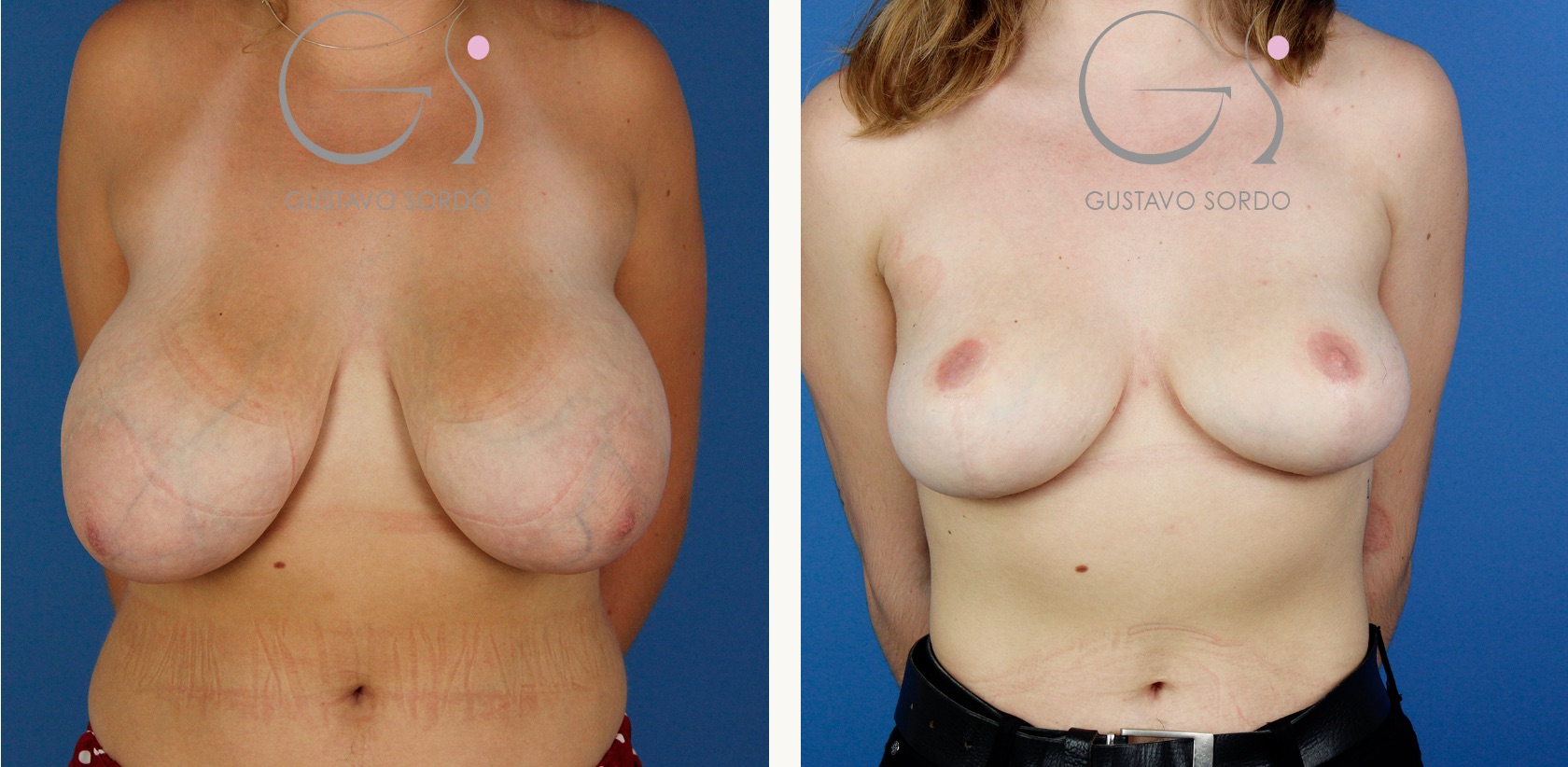 Reducción de mamas tuberosas