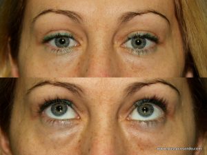 8.1-blefaroplastia