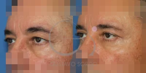 antes-despues-blefaroplastia-superior