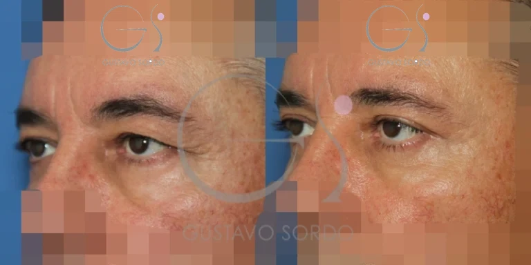antes-despues-blefaroplastia-superior