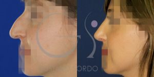 antes-despues-rinoplastia-mujer-31-anos