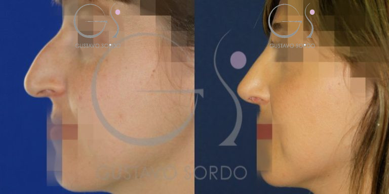 antes-despues-rinoplastia-mujer-31-anos