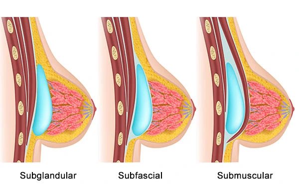colocacion-implante-mamario