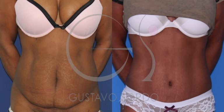 diastasis-abdominal