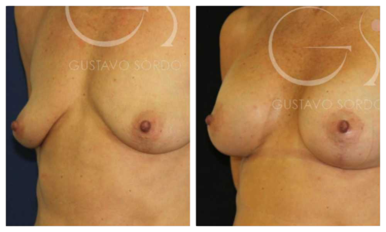 mastopexia-periareolar-en-madrid