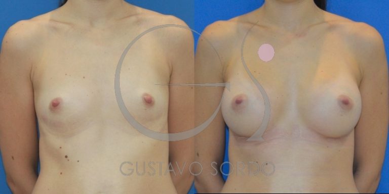 postoperatorio-aumento-pecho-recuperacion-aumento-mamas