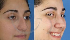 postoperatorio-rinoplastia-ultrasonica-recuperacion