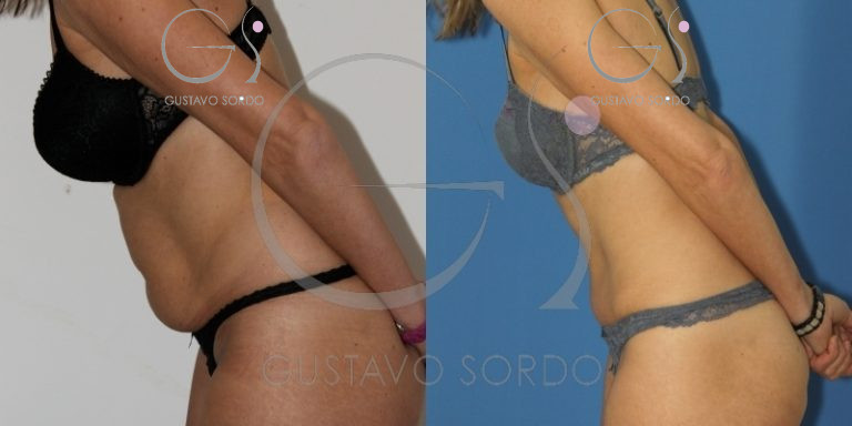 que-se-siente-despues-de-abdominoplastia