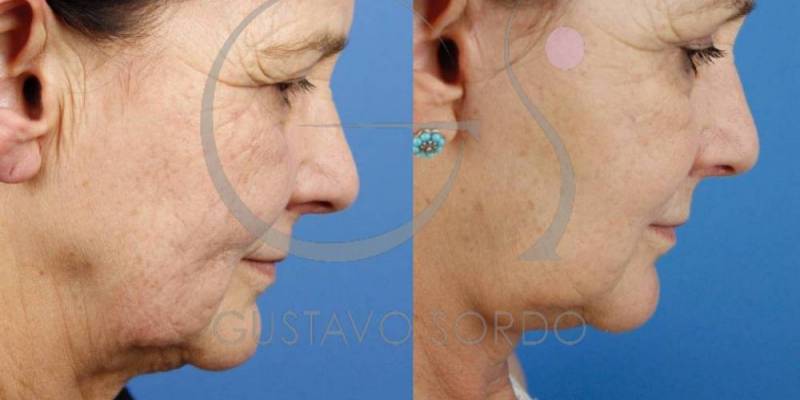 rejuvenecimiento-facial-lifting-frontal-cervicofacial-antes-despues