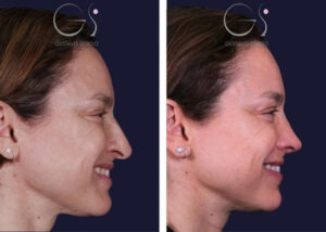 Rinoplastia — caso secundario en Madrid