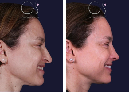 Rinoplastia — caso secundario en Madrid