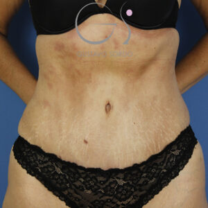 Liposucción y abdominoplastia en mujer de 45 años