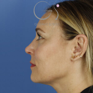 Ultrasonic rhinoplasty hanging columella and removed wing
