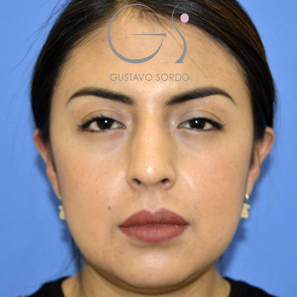 Rinoplastia Ultrasonica sobre Nariz Aguileña - Dr. Gustavo Sordo