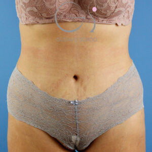Abdominoplastia en mujer con estrías