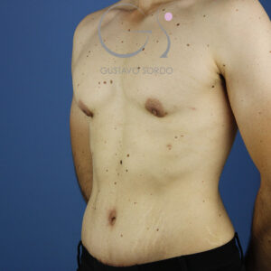 Gynaecomastie, abdominoplastiek en liposuctie