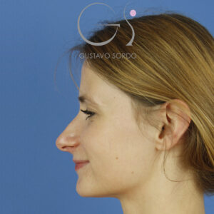 Ultrasonic rhinoplasty to correct bulbous tip
