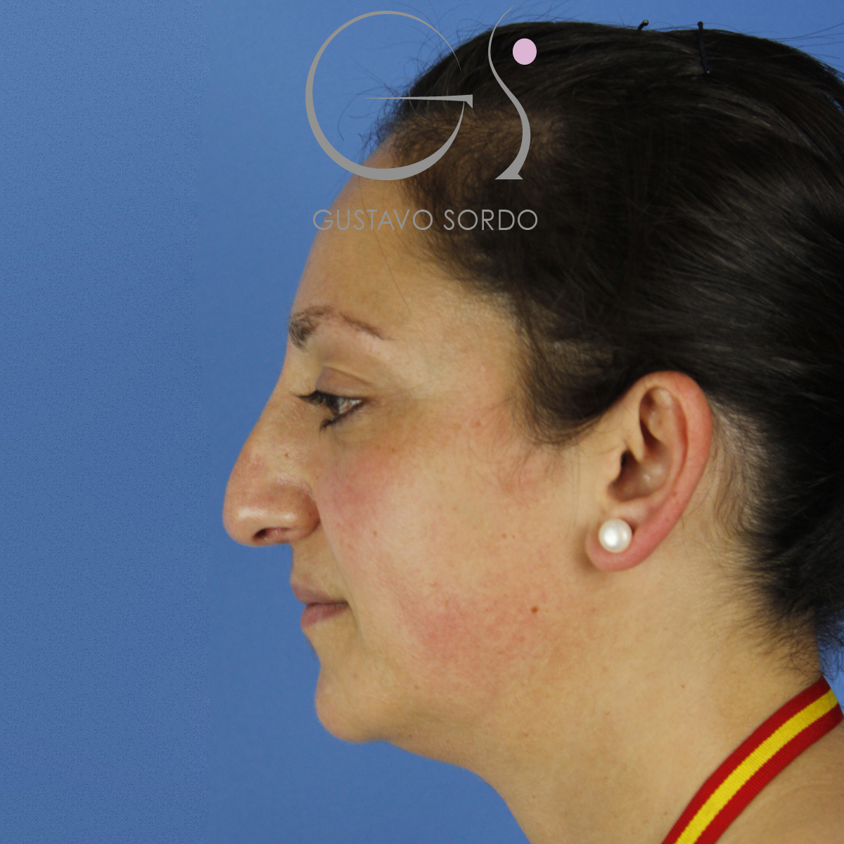 Transformación personal gracias a una rinoplastia, antes de la operación (1)