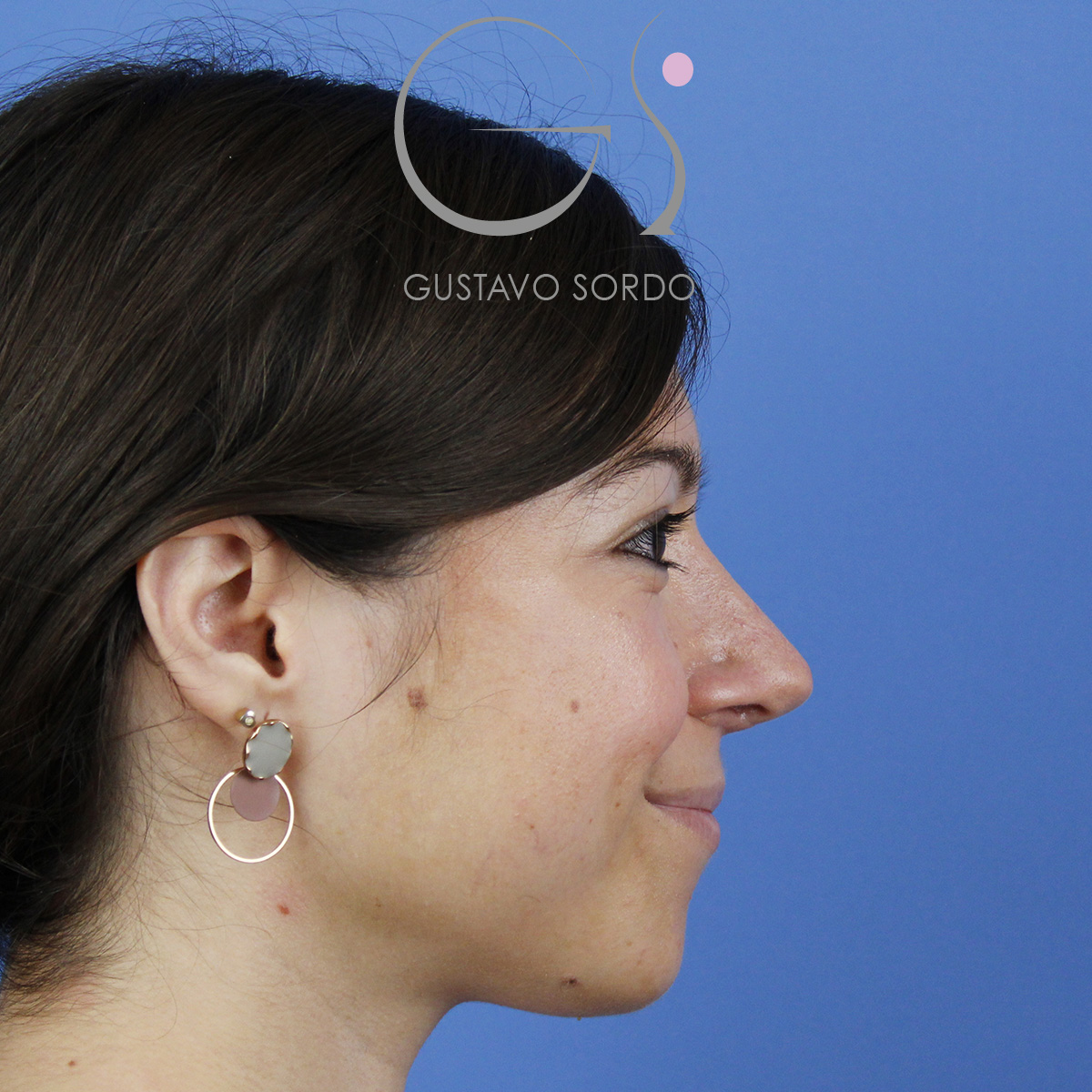 Rinoplastia ultrasónica mujer, resultado tras la cirugía — caso operado por el Dr. Gustavo Sordo en Madrid (1)