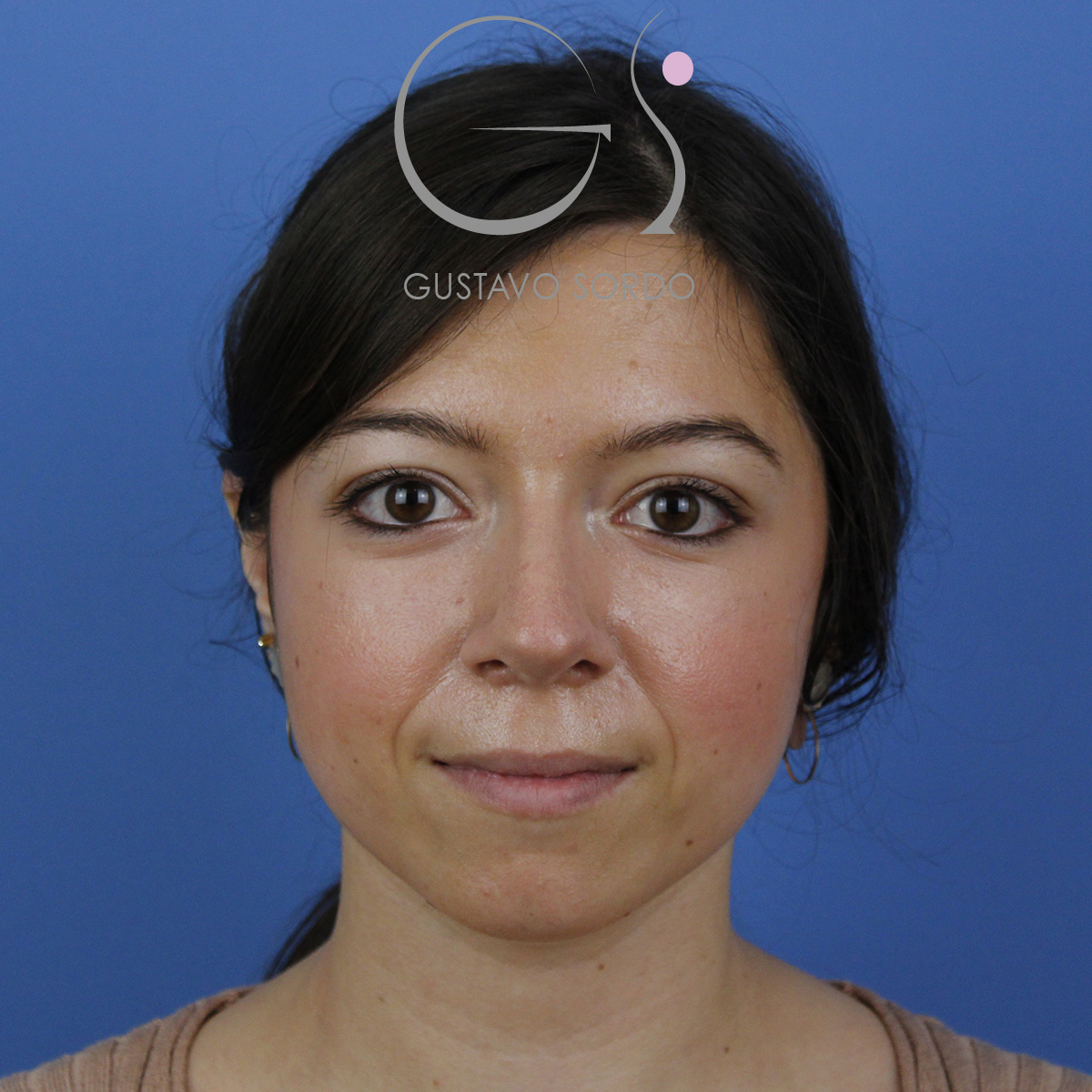 Rinoplastia ultrasónica mujer, resultado tras la cirugía — caso operado por el Dr. Gustavo Sordo en Madrid (2)