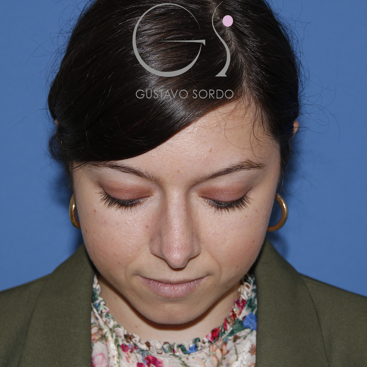 Rinoplastia ultrasónica mujer, antes de la cirugía — caso operado por el Dr. Gustavo Sordo en Madrid (4)