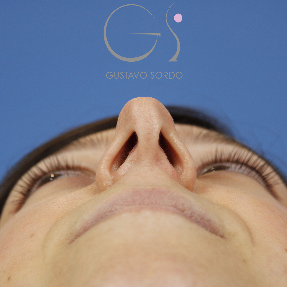 Rinoplastia ultrasónica mujer, antes de la cirugía — caso operado por el Dr. Gustavo Sordo en Madrid (5)