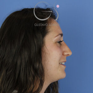 Ultrasonic rhinoplasty after 6 months