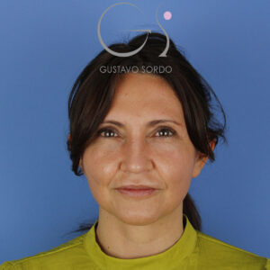 Ultrasone neuscorrectie en facelift