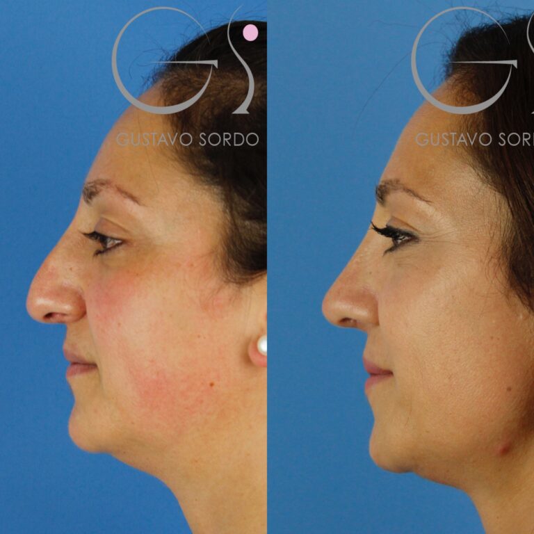 Rinoplastia: perfil antes y después de un caso operado por el Dr. Gustavo Sordo en Madrid