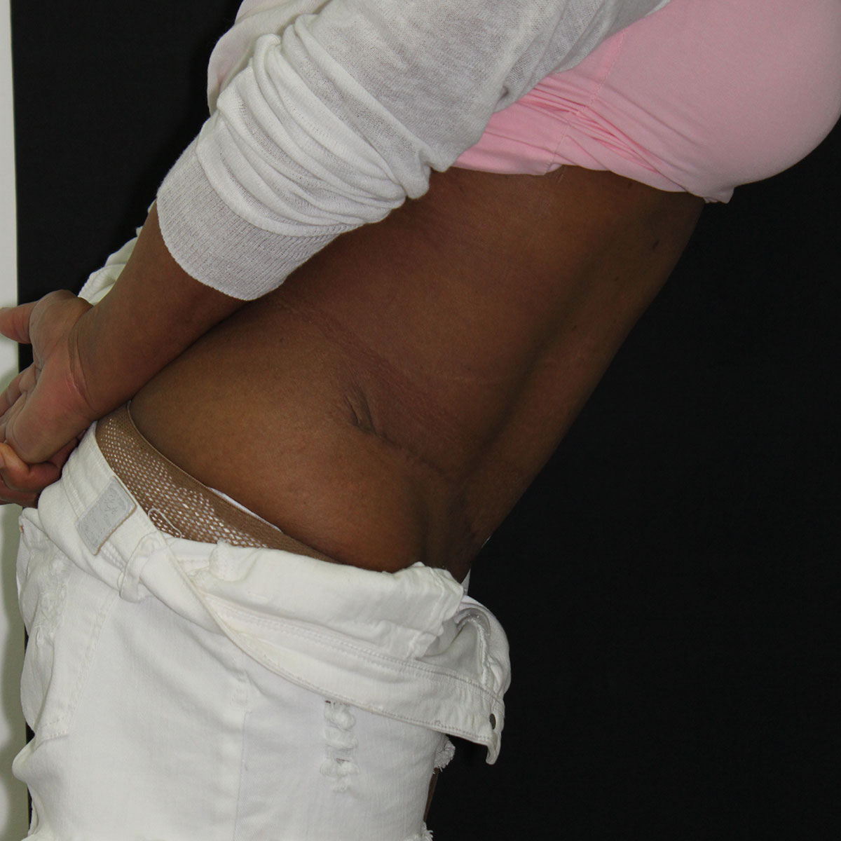 Abdominoplastia, resultado tras la cirugía — caso operado por el Dr. Gustavo Sordo en Madrid (4)