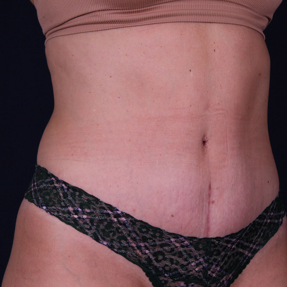 Abdominoplastia, resultado tras la cirugía — caso operado por el Dr. Gustavo Sordo en Madrid (5)