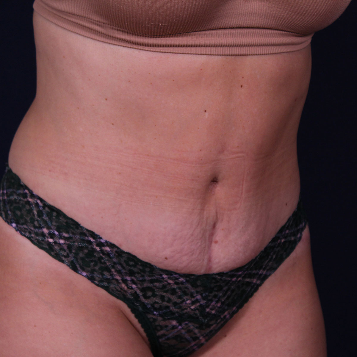 Abdominoplastia, resultado tras la cirugía — caso operado por el Dr. Gustavo Sordo en Madrid (6)