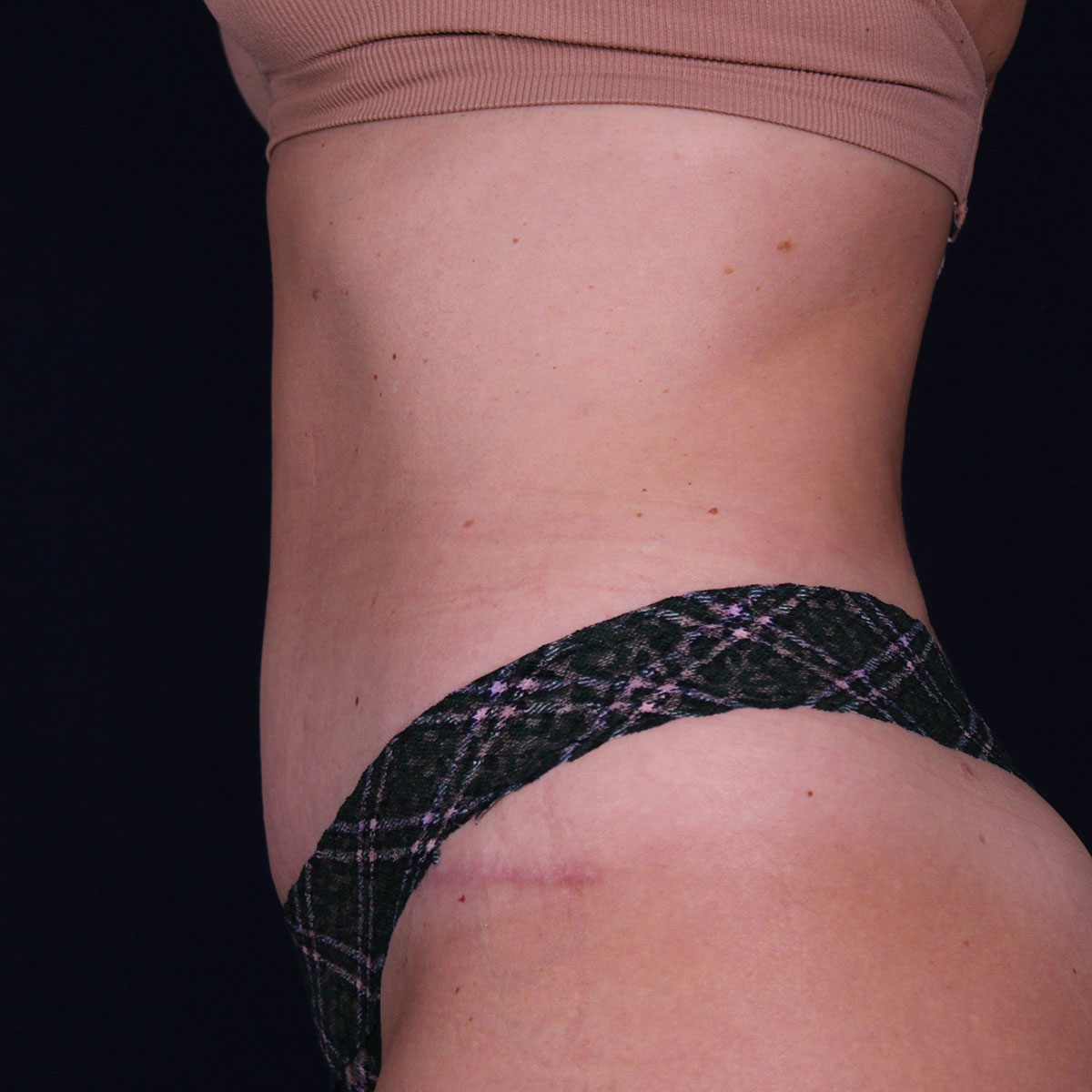 Abdominoplastia, resultado tras la cirugía — caso operado por el Dr. Gustavo Sordo en Madrid (7)