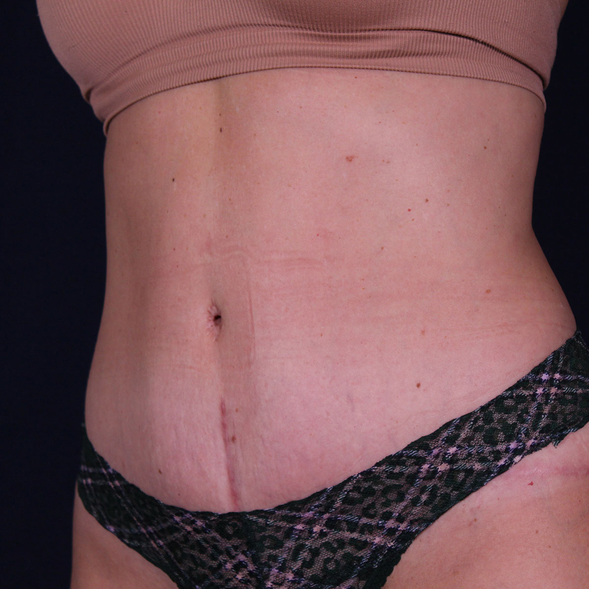 Abdominoplastia, resultado tras la cirugía — caso operado por el Dr. Gustavo Sordo en Madrid (9)