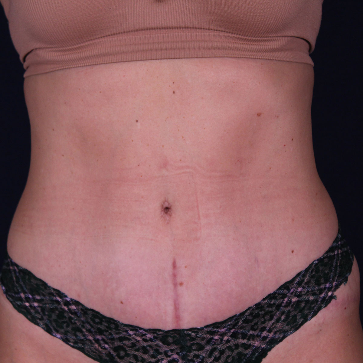 Abdominoplastia, resultado tras la cirugía — caso operado por el Dr. Gustavo Sordo en Madrid (1)