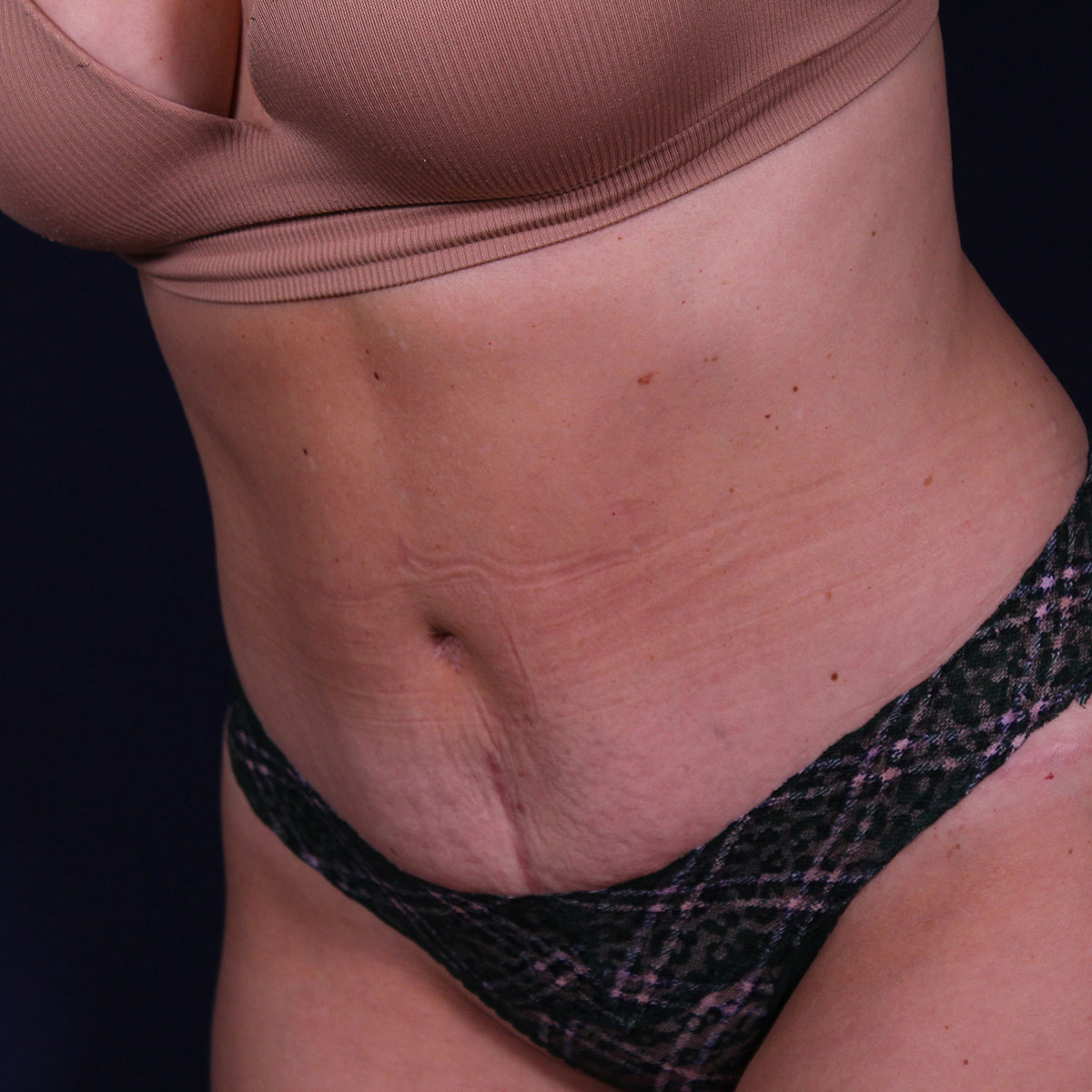Abdominoplastia, resultado tras la cirugía — caso operado por el Dr. Gustavo Sordo en Madrid (10)