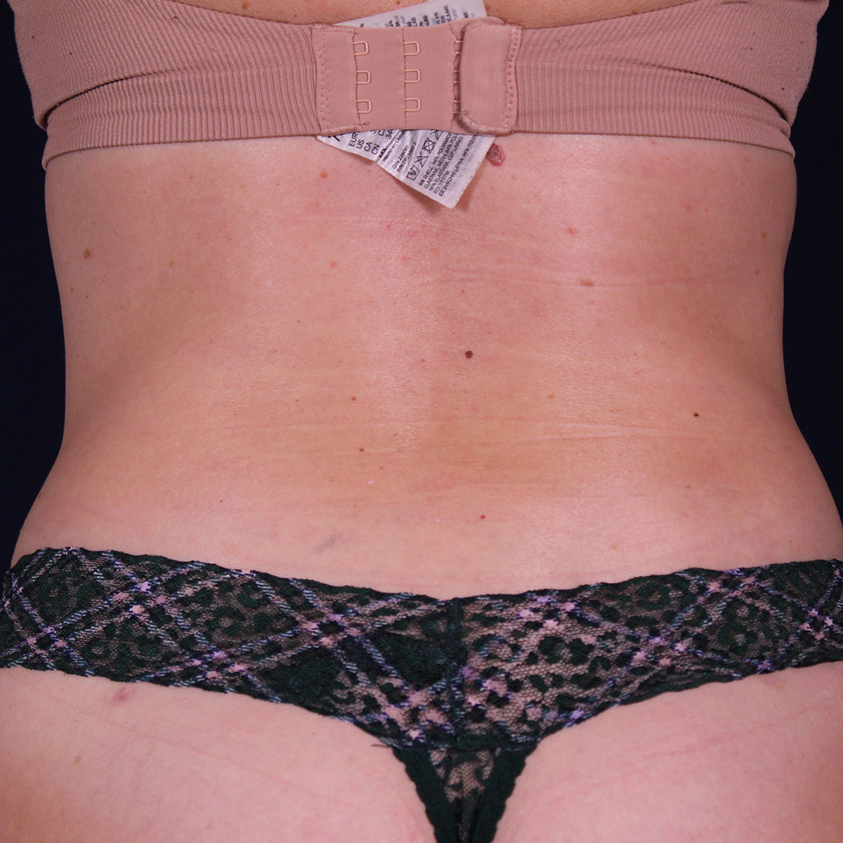 Abdominoplastia, resultado tras la cirugía — caso operado por el Dr. Gustavo Sordo en Madrid (11)