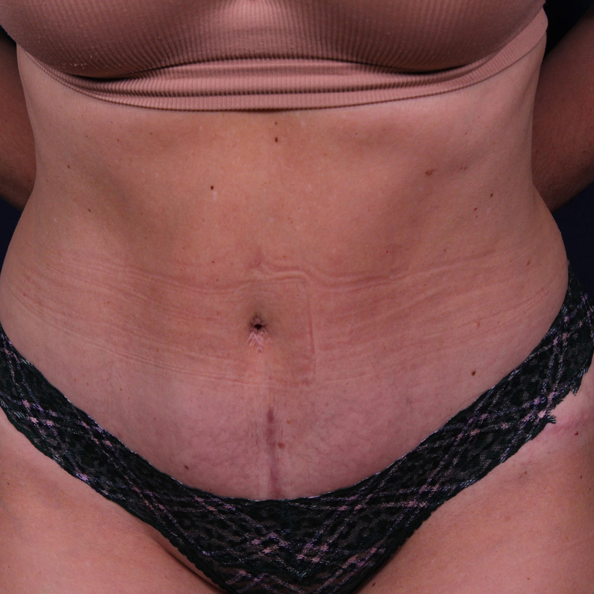 Abdominoplastia, resultado tras la cirugía — caso operado por el Dr. Gustavo Sordo en Madrid (2)