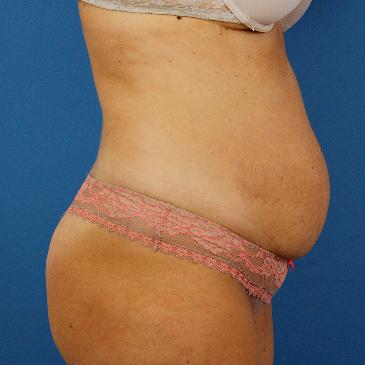 Abdominoplastia, antes de la cirugía — caso operado por el Dr. Gustavo Sordo en Madrid (3)